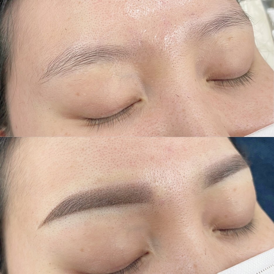  천안 눈썹문신 후 잔흔이 남았다면?