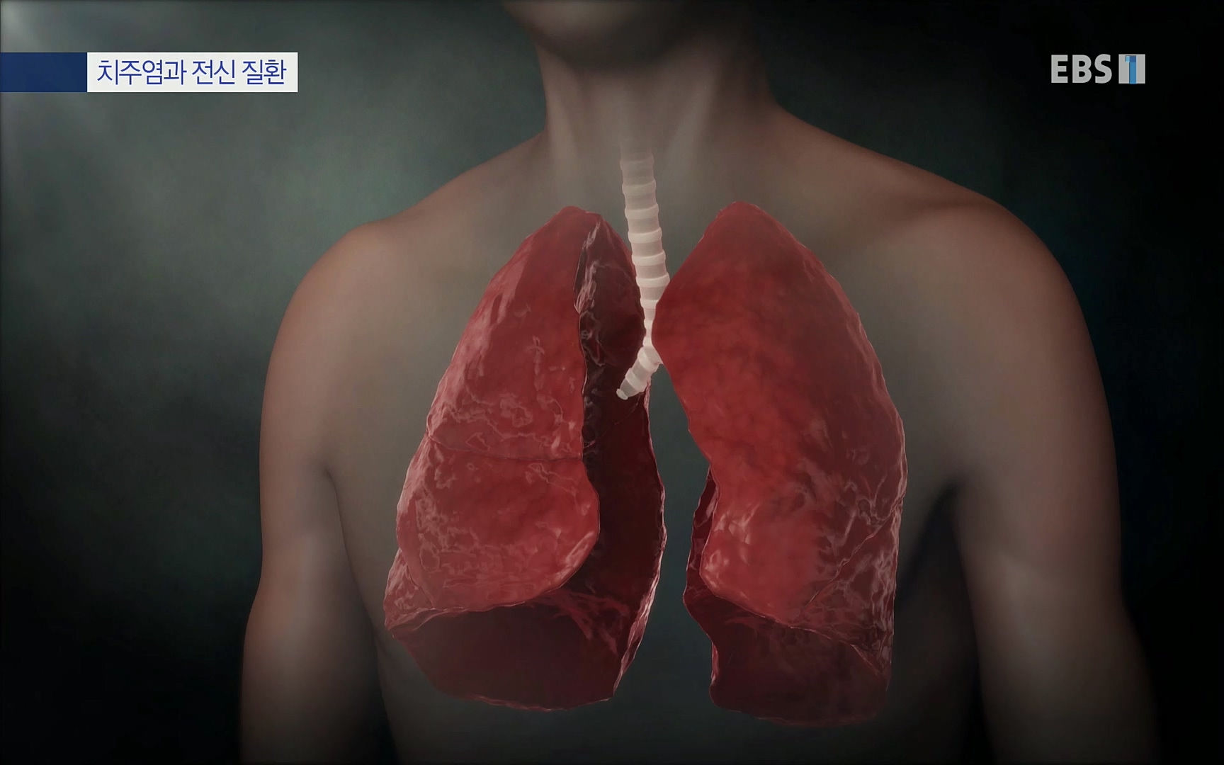 EBS 명의 헬스케어 - TV - 교육의 중심 EBS치주염이 코로나로 소홀해진 구강관리가 치아를 더 망가트리고 위험하게 만들며, 증상이 없기 때문에 특히 더 조심하고 치은염 단계에서 진행되지 않도록 예방해야한다 정의원 교수님과 치_20220505_151716.709.jpg