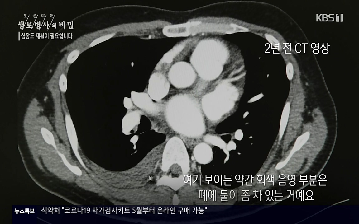 생로병사의 비밀.E820.220428p-NEXT.mp4_20220501_192749.260.jpg