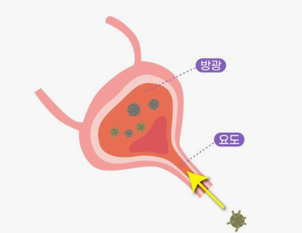방광염 원인