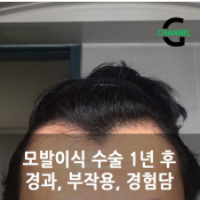  모발이식 수술 리뷰, 통증과 1년 후이야기