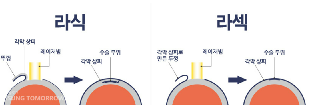 라식 라섹 차이점 비용 최저가 찾기 꿀Tip