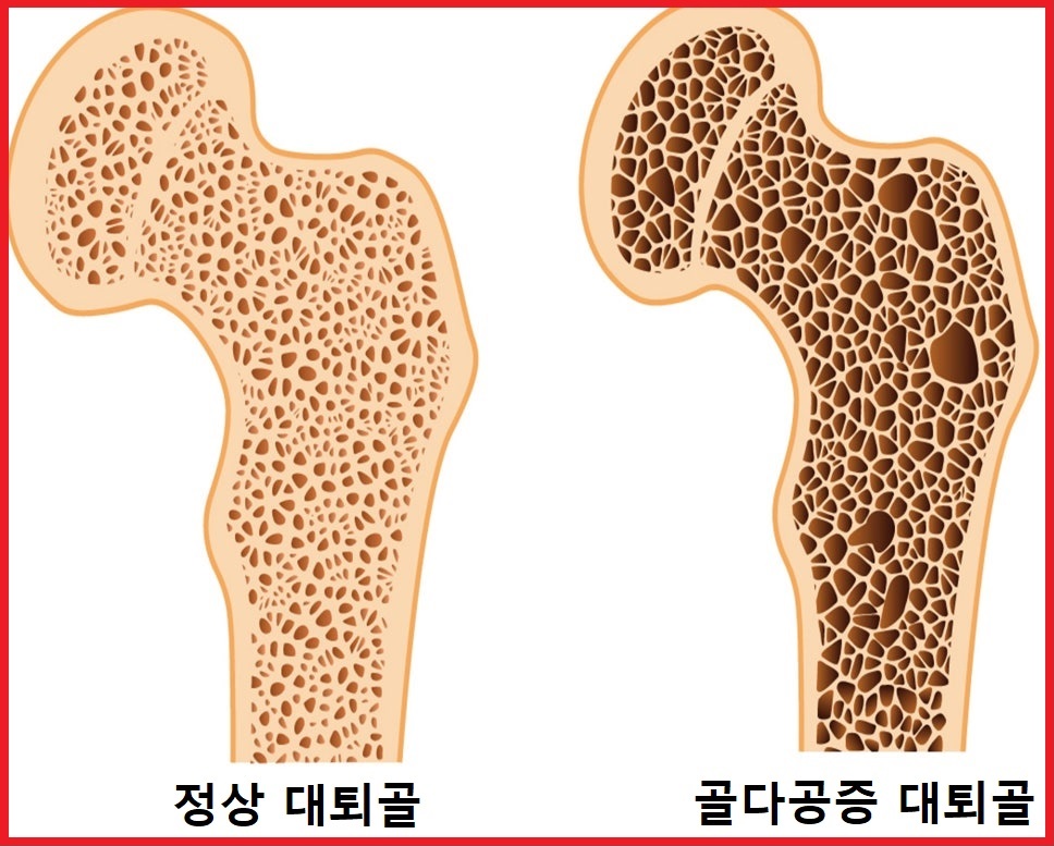 골다공증 대퇴골