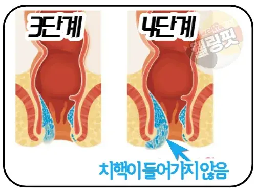 치핵-2단계와-3단계