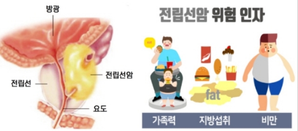 전립선암 초기증상 원인 자가진단 정보 총정리3