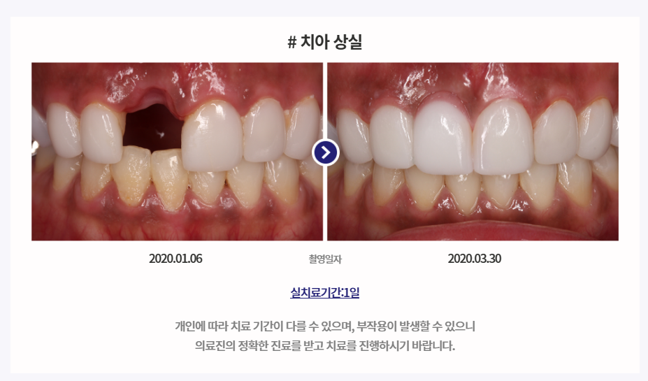 미니쉬 치과병원&#44; 미니쉬 가격 아세요 (완벽정리)