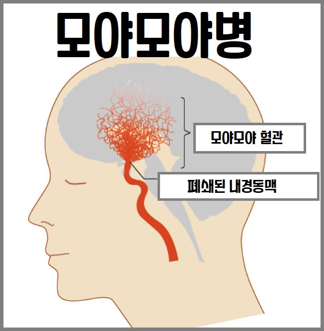 모야모야병