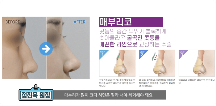 매부리코 성형수술 - 정진욱원장