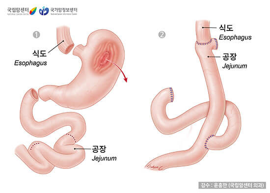 위전절제술(출처 : 국립암정보센터)