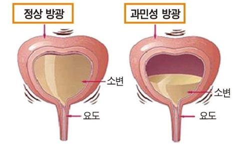 과민성 방광 치료방법 원인과 수술 증상