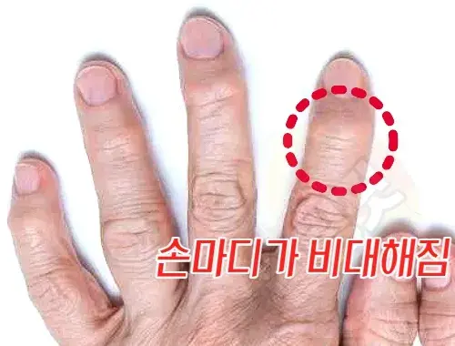 손가락-관절염이-있으면-손-마디-관절이-비대해-집니다.