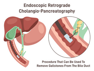 ERCP