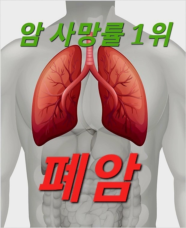  폐질환<폐암>