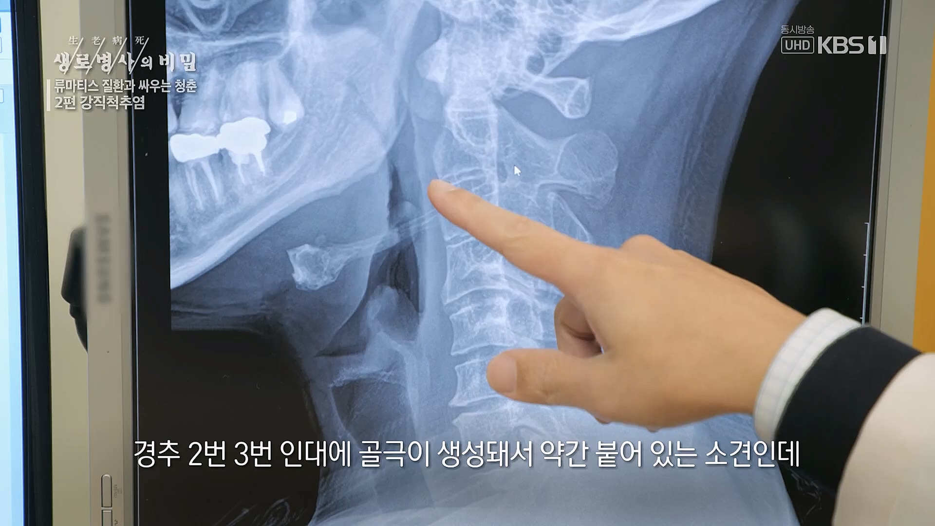 생로병사의 비밀.E861.230322p.H264-F1RST.mp4_20230323_204411.273.jpg