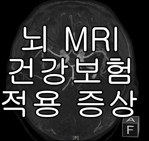  건강보험 적용되는 뇌 MRI 증상과 비용은??