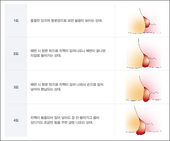 치질 증상 / 치질 자연 치유 요법 권장 사항 7