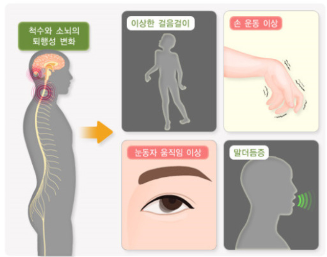 소뇌위축증 유익한 균형 훈련 방법