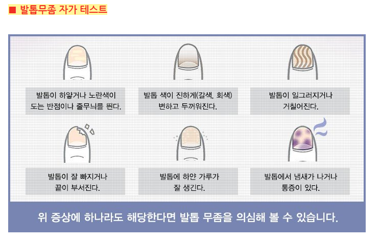 발톱무좀