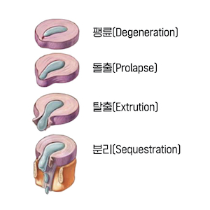 허리 디스크가 터지면 꼭 수술해야 하나요?