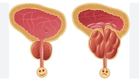 전립선비대증 치료