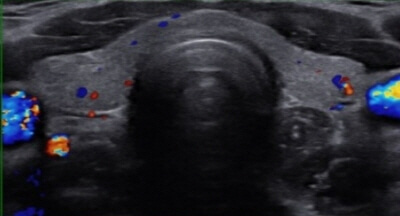 갑상선기능검사를받기위해-초음파사진으로-검사하는방법을알려주기위한이미지의사진