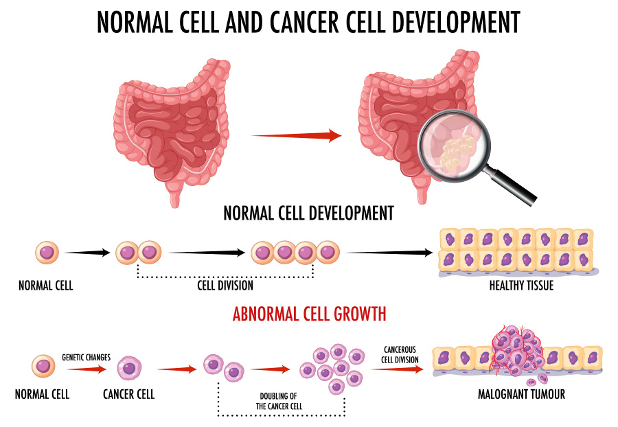 정상적인 대장의 이미지와 대장암이 진행되고 있는 대장의 이미지와 정상적인 세포가 암으로 진행되고 있는 과정을 이미지화 한 사진