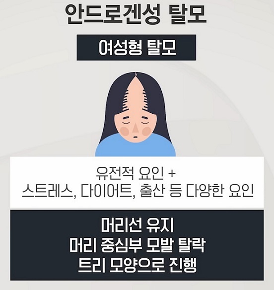 안드로겐성탈모(여성)