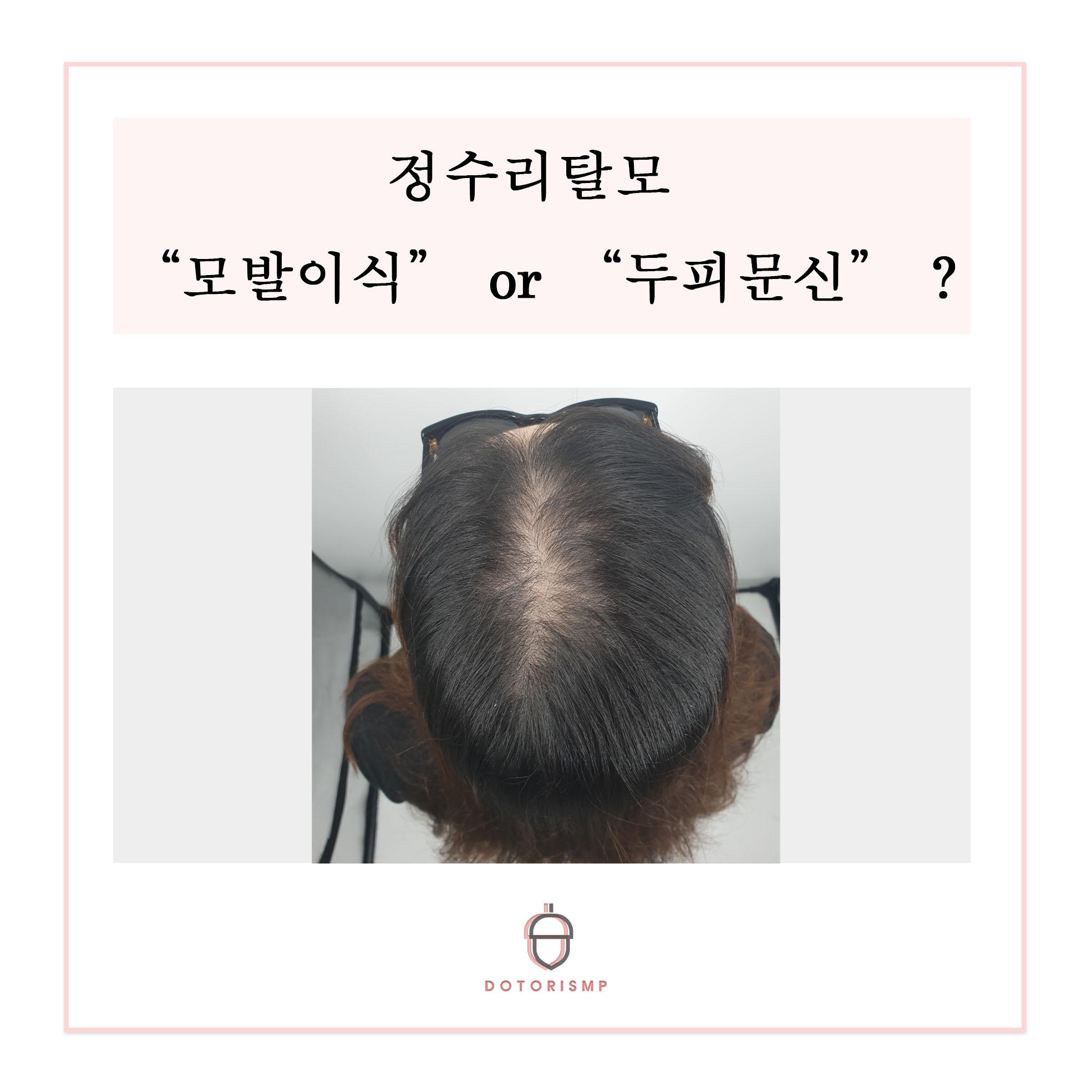  [부산두피문신] "정수리탈모" 모발이식? 두피문신 ?