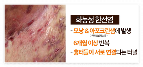 화농성 한산염