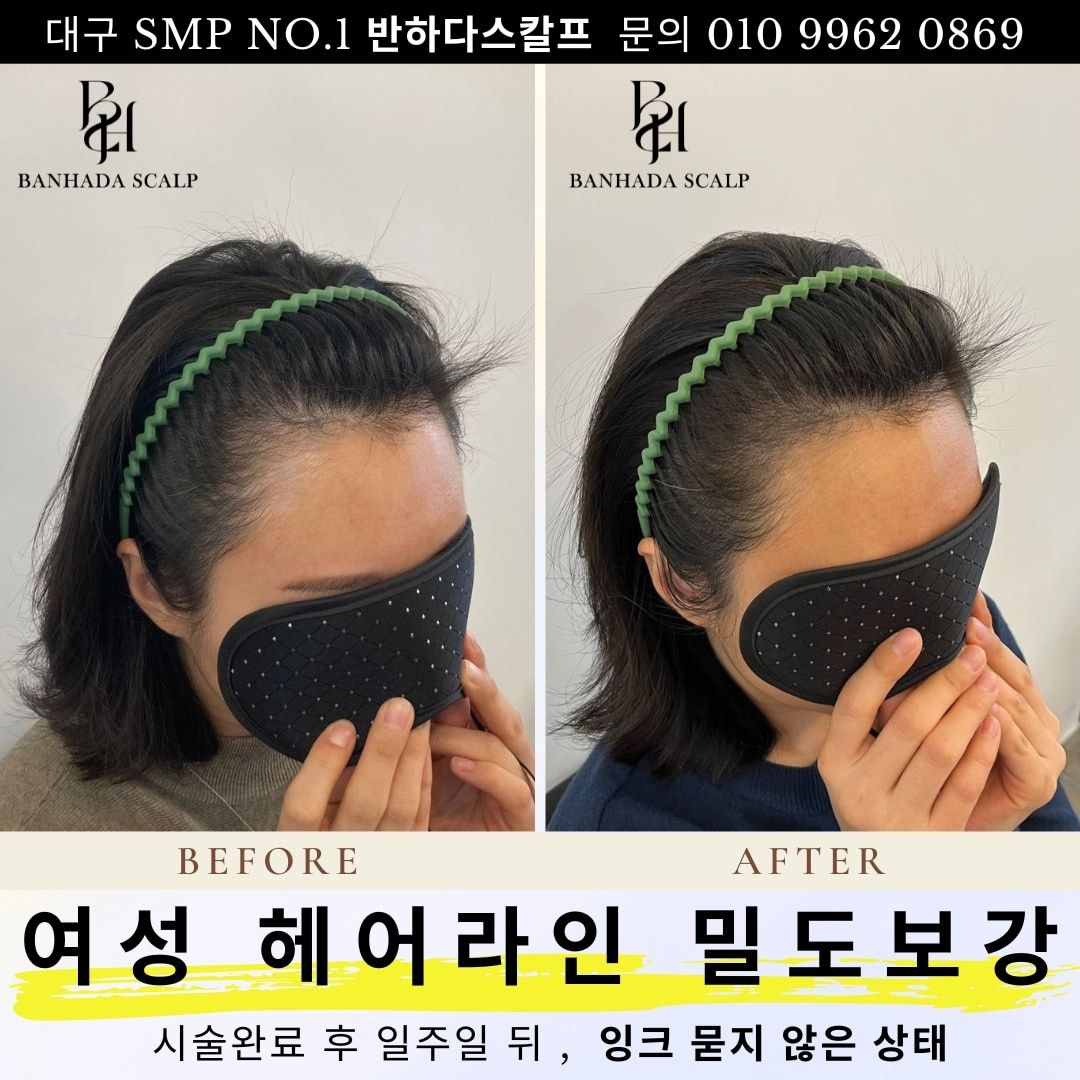 대구 헤어라인교정, 헤어라인반영구, 3