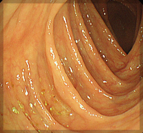  건강 보험 국가 건강 검진  대장 내시경 (colono scophy) [검사 방법 검사 시간]
