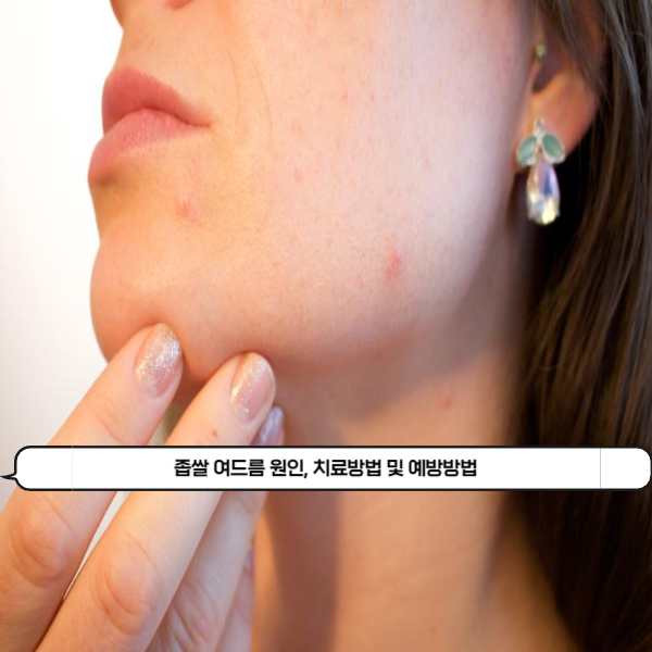  붉은 염증이 나타나는 좁쌀여드름이 생기는 원인, 치료방법 및 예방방법