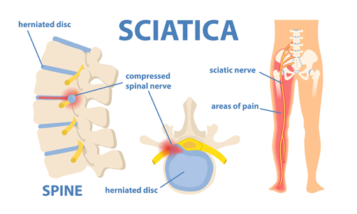 척추사이원반이 튀어나와 좌골신경을 압박하는 과정에서 발생하는 좌골신경통을 표현한 그림