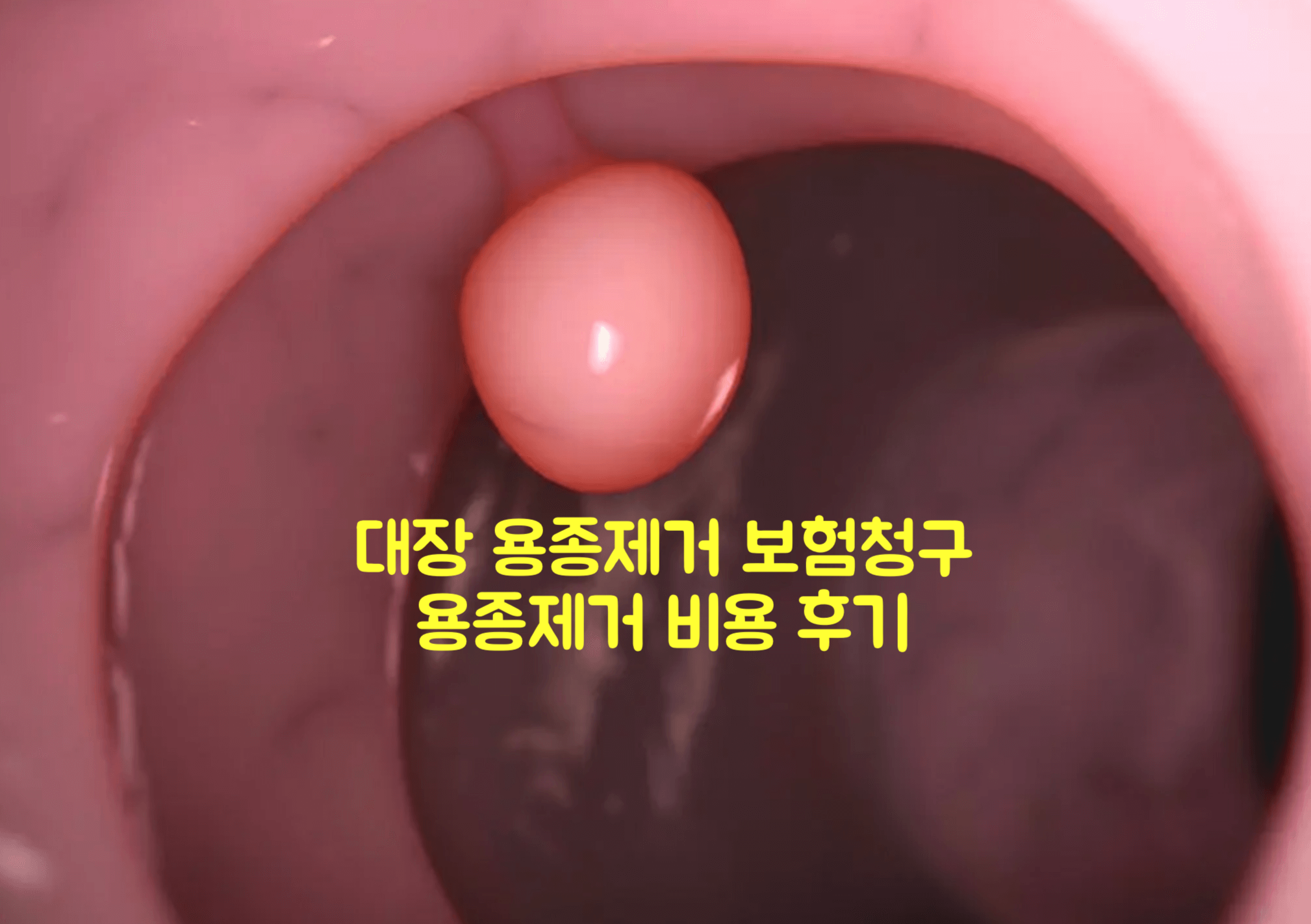 대장 용종제거