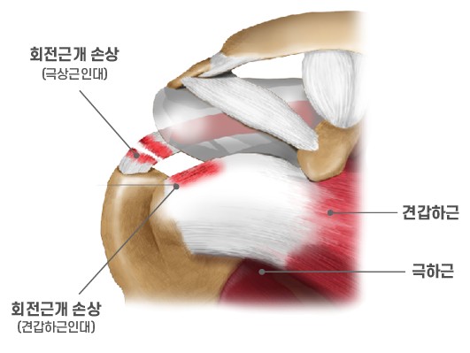 어깨회전근개 파열&#44; 증상에 따른 치료방법