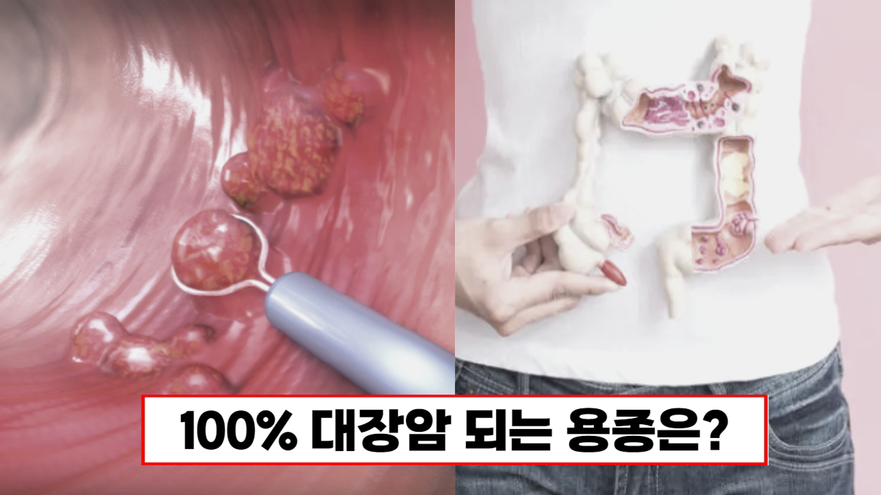 “이 용종은 꼭 절제하세요” 100% 대장암으로 진행됩니다