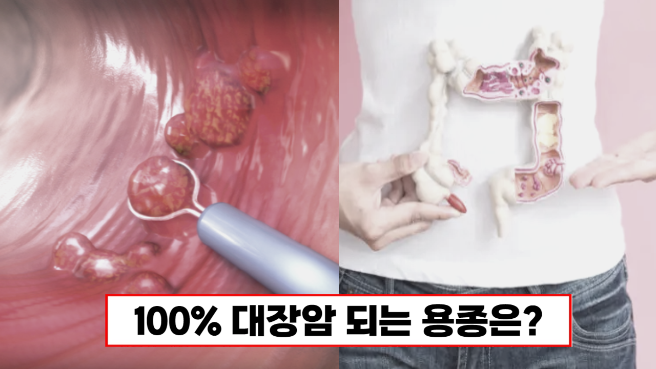 "이 용종은 꼭 절제하세요" 100% 대장암으로 진행됩니다