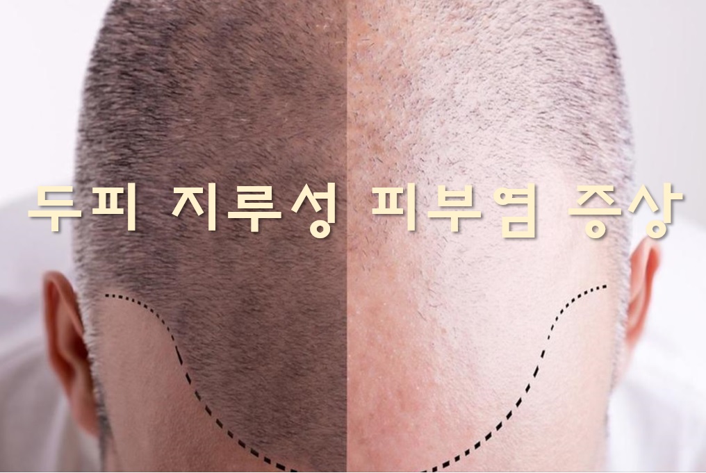  두피 지루성 피부염 증상과 치료 방법