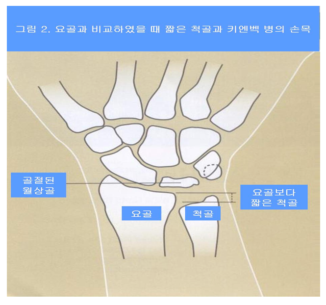 키엔백병 출처 대한 정형외과 홈페이지