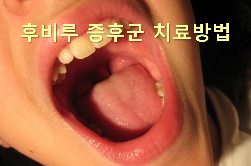  후비루 증후군 치료방법과 후비루 증후군에 좋은 음식