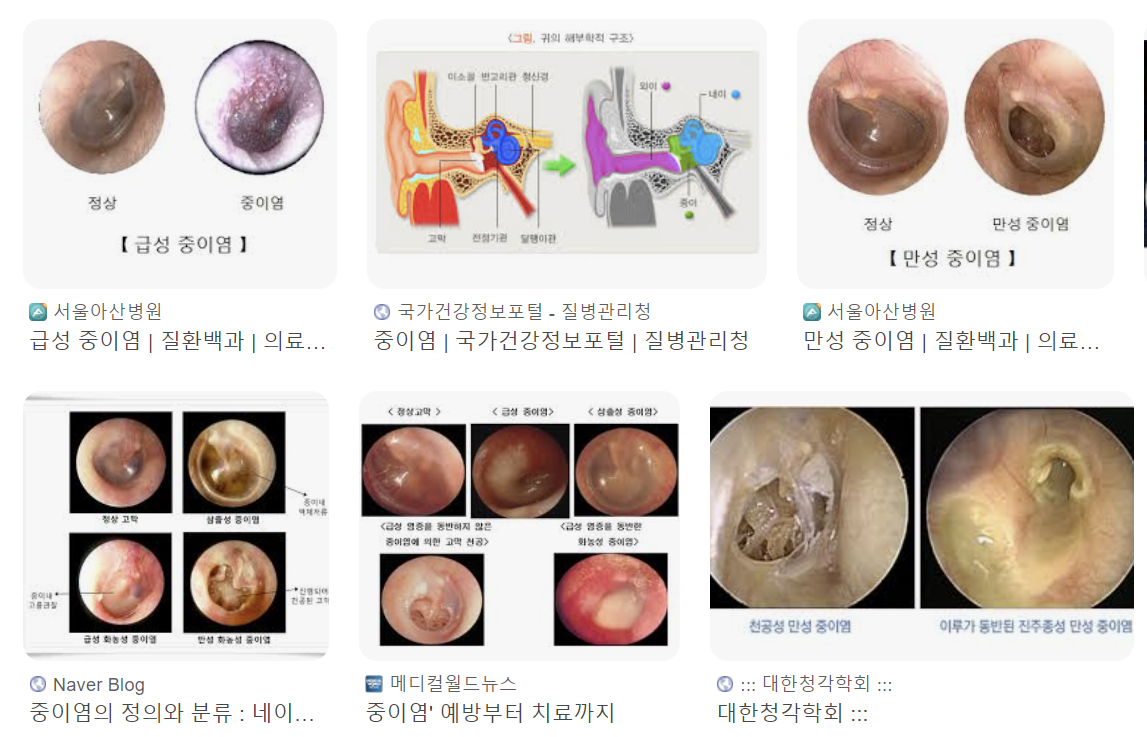 중이염 증상 2