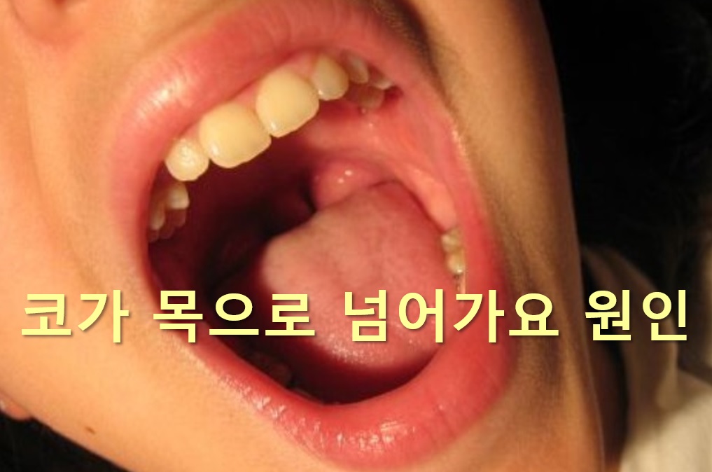  코가 목으로 넘어가요 원인 되는 후비루 증상