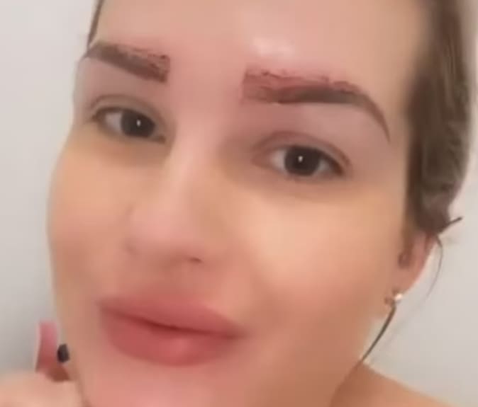 자신의 머리 털로 눈썹 이식한 10대...어머! 숯덩이네! VIDEO:Cotswolds woman undergoes eyebrow transplant using hairs from head