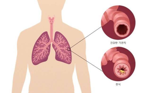 천식 증상