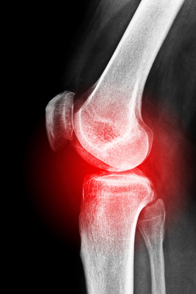 성장통 / 오스굿-슐라터병(Osgood-Schlatter disease) 양산 통증클리닉 - 3