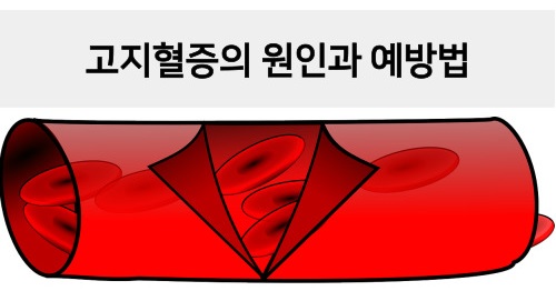  고지혈증에 대해 알아보고, 예방법도 같이 알아보자