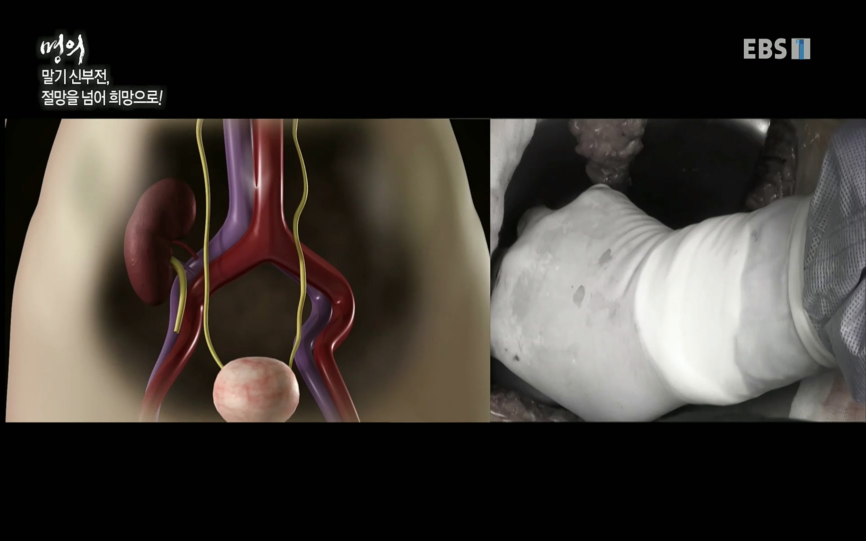 EBS 명의 헬스케어 - TV - 교육의 중심 EBS명의 15년 - 만성 콩팥병 치료, 어디까지 왔나- .mp4_20220802_205720.992.jpg