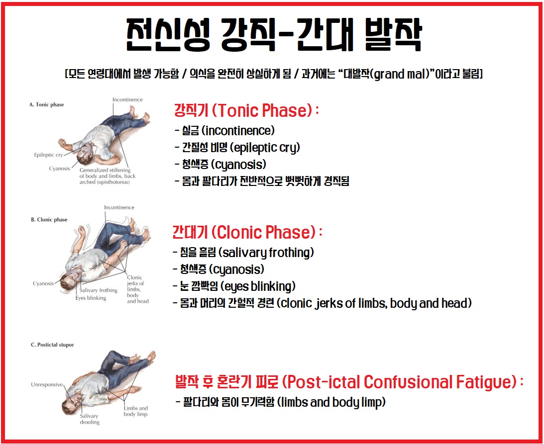 강직 간대 발작 병태생리와 특징 완벽 정리