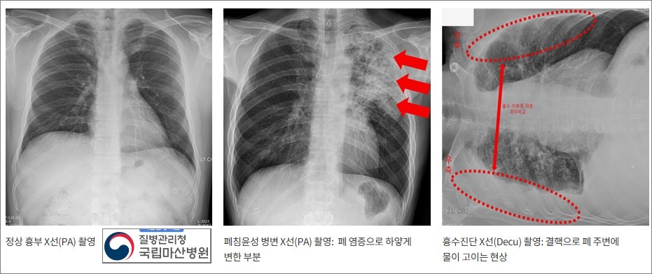 흉부-X레이