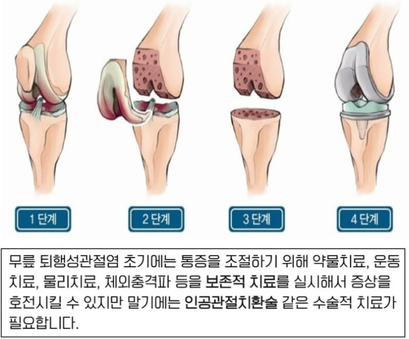 턱관절 통증 소리 치료방법 (실제후기)